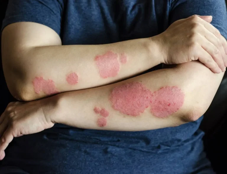 Osoba w ciemnym, krótkim topie z widocznymi czerwonymi, zapalonymi plamami na skórze. Tło jest niewyraźne i nie dostarcza dodatkowego kontekstu. Jeśli doświadczasz takich objawów skórnych, zaleca się konsultację z lekarzem. Może to być objaw egzemy, łuszczycy lub innej choroby skórnej, które wymagają profesjonalnej diagnozy i leczenia.